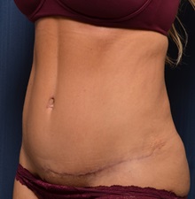 Tummy Tuck After Photo by Michael Frederick, MD; Fort Lauderdale, FL - Case 36568