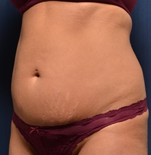 Tummy Tuck Before Photo by Michael Frederick, MD; Fort Lauderdale, FL - Case 36568