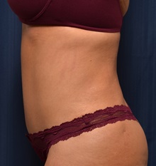 Tummy Tuck After Photo by Michael Frederick, MD; Fort Lauderdale, FL - Case 36568