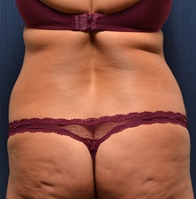 Tummy Tuck Before Photo by Michael Frederick, MD; Fort Lauderdale, FL - Case 36568