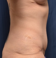 Tummy Tuck After Photo by Michael Frederick, MD; Fort Lauderdale, FL - Case 36569
