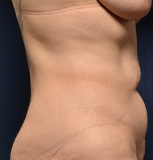 Tummy Tuck Before Photo by Michael Frederick, MD; Fort Lauderdale, FL - Case 36569