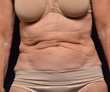 Tummy Tuck Before Photo by Michael Frederick, MD; Fort Lauderdale, FL - Case 36570