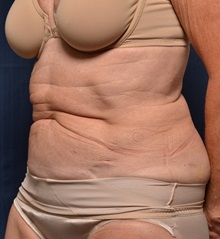 Tummy Tuck Before Photo by Michael Frederick, MD; Fort Lauderdale, FL - Case 36570