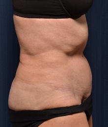 Tummy Tuck After Photo by Michael Frederick, MD; Fort Lauderdale, FL - Case 36570