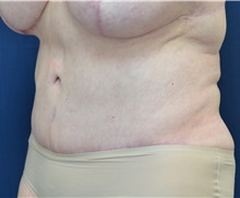 Tummy Tuck After Photo by Michael Frederick, MD; Fort Lauderdale, FL - Case 36573