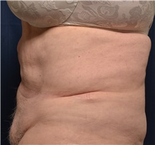 Tummy Tuck Before Photo by Michael Frederick, MD; Fort Lauderdale, FL - Case 36573