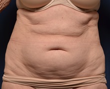 Tummy Tuck Before Photo by Michael Frederick, MD; Fort Lauderdale, FL - Case 36575