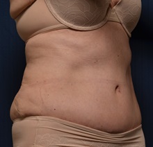 Tummy Tuck After Photo by Michael Frederick, MD; Fort Lauderdale, FL - Case 36575