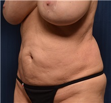 Tummy Tuck Before Photo by Michael Frederick, MD; Fort Lauderdale, FL - Case 36614