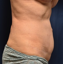 Tummy Tuck After Photo by Michael Frederick, MD; Fort Lauderdale, FL - Case 36614