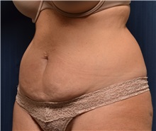 Tummy Tuck Before Photo by Michael Frederick, MD; Fort Lauderdale, FL - Case 36615