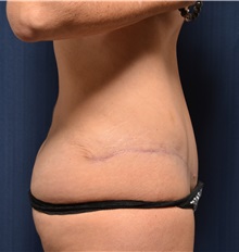 Tummy Tuck After Photo by Michael Frederick, MD; Fort Lauderdale, FL - Case 36615