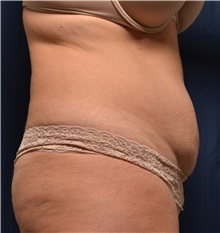 Tummy Tuck Before Photo by Michael Frederick, MD; Fort Lauderdale, FL - Case 36615