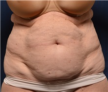 Tummy Tuck Before Photo by Michael Frederick, MD; Fort Lauderdale, FL - Case 36617