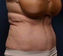 Tummy Tuck After Photo by Michael Frederick, MD; Fort Lauderdale, FL - Case 36617