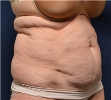 Tummy Tuck Before Photo by Michael Frederick, MD; Fort Lauderdale, FL - Case 36617