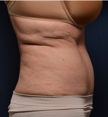 Tummy Tuck After Photo by Michael Frederick, MD; Fort Lauderdale, FL - Case 36617