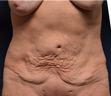 Tummy Tuck Before Photo by Michael Frederick, MD; Fort Lauderdale, FL - Case 36619