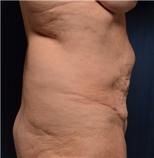 Tummy Tuck Before Photo by Michael Frederick, MD; Fort Lauderdale, FL - Case 36619