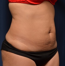 Tummy Tuck Before Photo by Michael Frederick, MD; Fort Lauderdale, FL - Case 36620