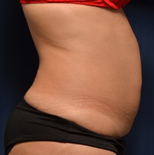 Tummy Tuck Before Photo by Michael Frederick, MD; Fort Lauderdale, FL - Case 36620