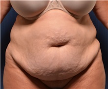 Tummy Tuck Before Photo by Michael Frederick, MD; Fort Lauderdale, FL - Case 36829