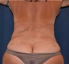 Tummy Tuck After Photo by Michael Frederick, MD; Fort Lauderdale, FL - Case 36829