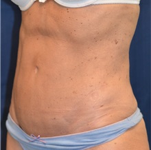 Tummy Tuck After Photo by Michael Frederick, MD; Fort Lauderdale, FL - Case 36896