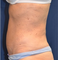 Tummy Tuck After Photo by Michael Frederick, MD; Fort Lauderdale, FL - Case 36896