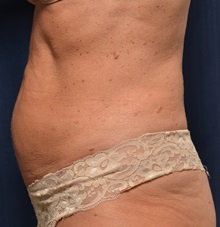 Tummy Tuck Before Photo by Michael Frederick, MD; Fort Lauderdale, FL - Case 36896