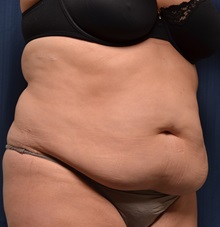 Tummy Tuck Before Photo by Michael Frederick, MD; Fort Lauderdale, FL - Case 36897