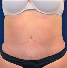 Tummy Tuck After Photo by Michael Frederick, MD; Fort Lauderdale, FL - Case 36897