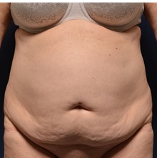 Tummy Tuck Before Photo by Michael Frederick, MD; Fort Lauderdale, FL - Case 36992
