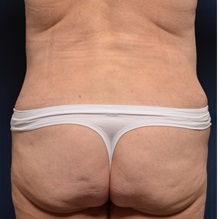 Tummy Tuck After Photo by Michael Frederick, MD; Fort Lauderdale, FL - Case 36992