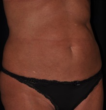 Tummy Tuck Before Photo by Michael Frederick, MD; Fort Lauderdale, FL - Case 36994