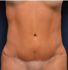Tummy Tuck After Photo by Michael Frederick, MD; Fort Lauderdale, FL - Case 36995