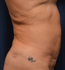 Tummy Tuck Before Photo by Michael Frederick, MD; Fort Lauderdale, FL - Case 36995
