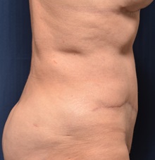 Tummy Tuck After Photo by Michael Frederick, MD; Fort Lauderdale, FL - Case 37004