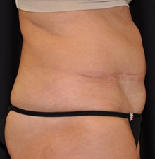 Tummy Tuck Before Photo by Michael Frederick, MD; Fort Lauderdale, FL - Case 37004