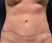 Tummy Tuck After Photo by Michael Frederick, MD; Fort Lauderdale, FL - Case 37004