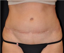 Tummy Tuck Before Photo by Michael Frederick, MD; Fort Lauderdale, FL - Case 37004