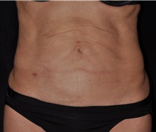 Tummy Tuck Before Photo by Michael Frederick, MD; Fort Lauderdale, FL - Case 37006