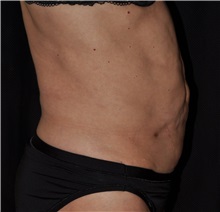 Tummy Tuck Before Photo by Michael Frederick, MD; Fort Lauderdale, FL - Case 37006
