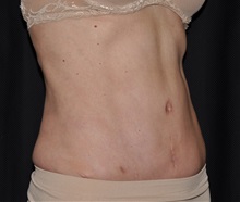 Tummy Tuck After Photo by Michael Frederick, MD; Fort Lauderdale, FL - Case 37006