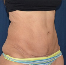 Tummy Tuck After Photo by Michael Frederick, MD; Fort Lauderdale, FL - Case 37008