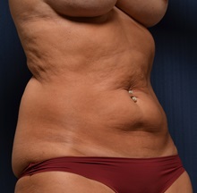 Tummy Tuck Before Photo by Michael Frederick, MD; Fort Lauderdale, FL - Case 37008