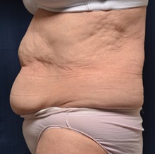 Tummy Tuck Before Photo by Michael Frederick, MD; Fort Lauderdale, FL - Case 37010