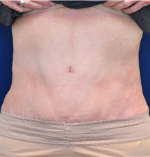 Tummy Tuck After Photo by Michael Frederick, MD; Fort Lauderdale, FL - Case 37010