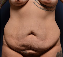 Tummy Tuck Before Photo by Michael Frederick, MD; Fort Lauderdale, FL - Case 37025